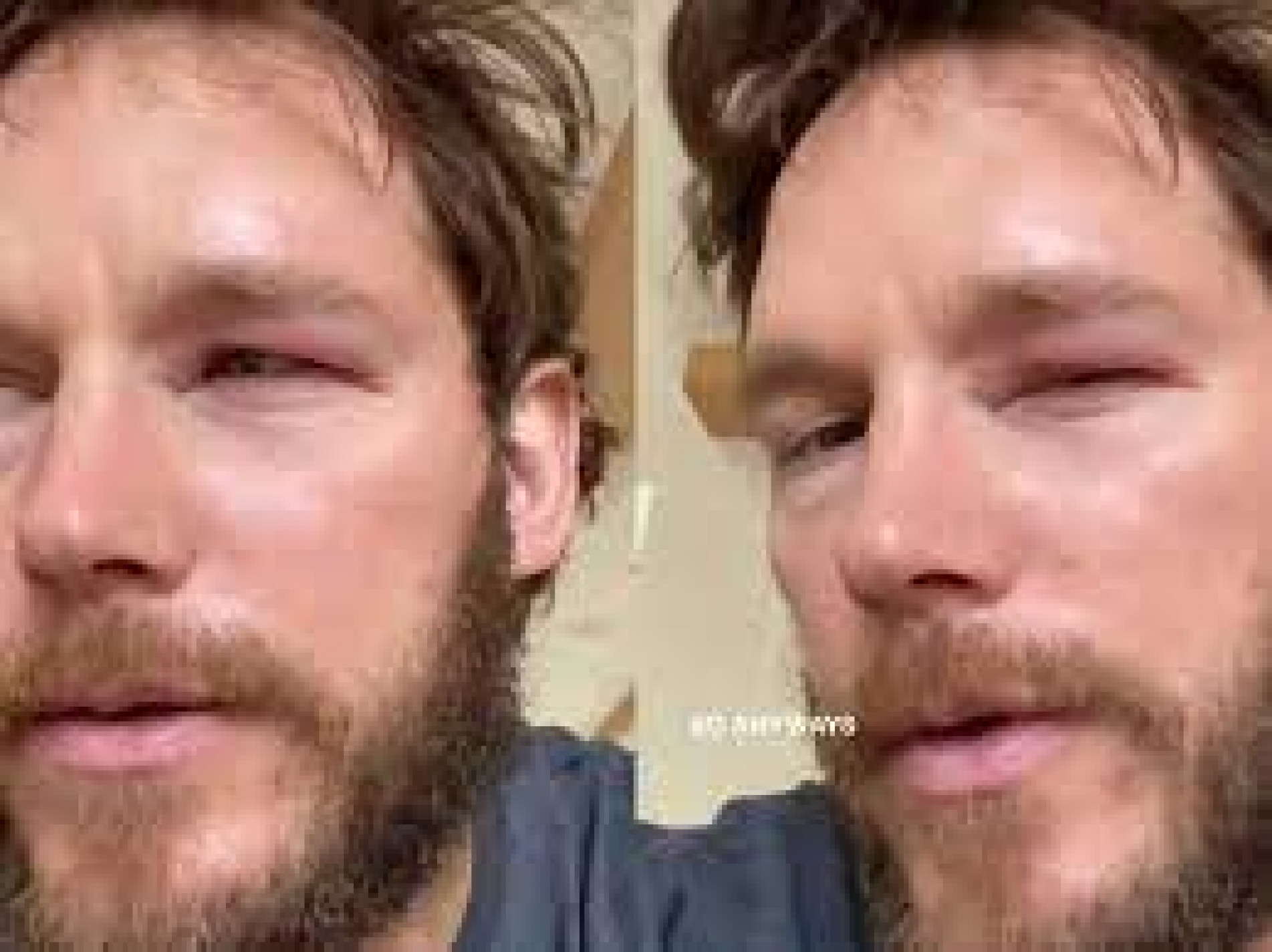 Ator Chris Pratt é picado por abelha 